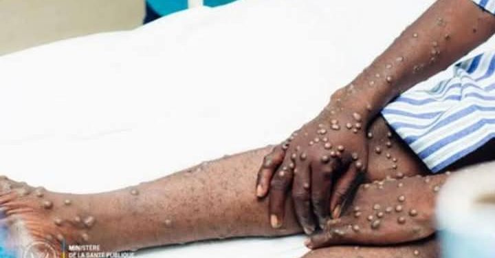 RDC : 1,5 Million de Doses du Vaccin LC16m8 Attenues le 29 mai prochain à Kinshasa pour Lutter Contre le Mpox
