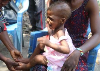 RDC : Au moins 3 207 enfants souffrent de malnutrition aiguë sévère (MAS) dans la province du Nord-Kivu