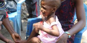 RDC : Au moins 3 207 enfants souffrent de malnutrition aiguë sévère (MAS) dans la province du Nord-Kivu