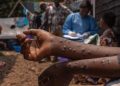 Santé : Plus de 608 cas de Mpox (variole simienne) enregistrés à l’espace d’une semaine en RDC (Document)