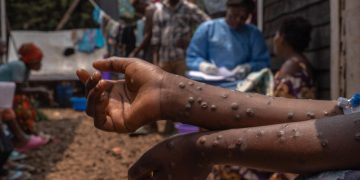 Santé : Plus de 608 cas de Mpox (variole simienne) enregistrés à l&rsquo;espace d&rsquo;une semaine en RDC (Document)