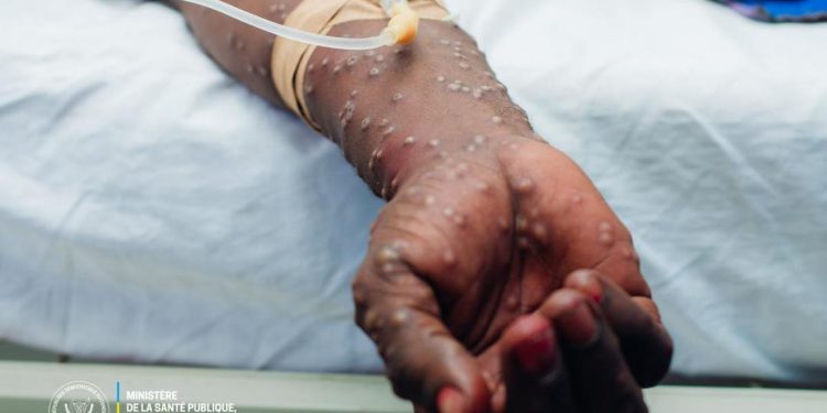  Mpox : au moins 15 décès enregistrés dans la province du Sud-Kivu